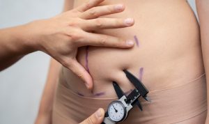 chirurgie de l'obésité Tunisie