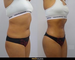 Abdominoplastie Tunisie